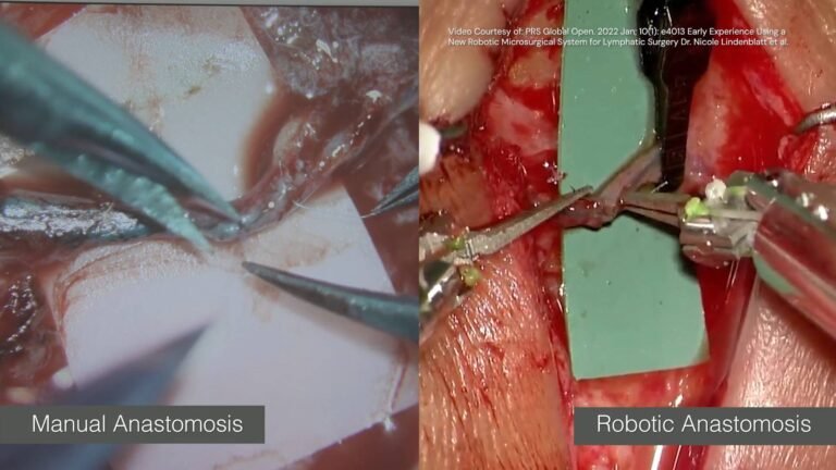 Robotic vs Manual Anastomosis Side by Side min 768x432